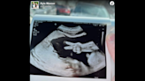 Expectant parents spot baby’s ‘peace sign’ during ultrasound. ‘Gonna be one cool kid’