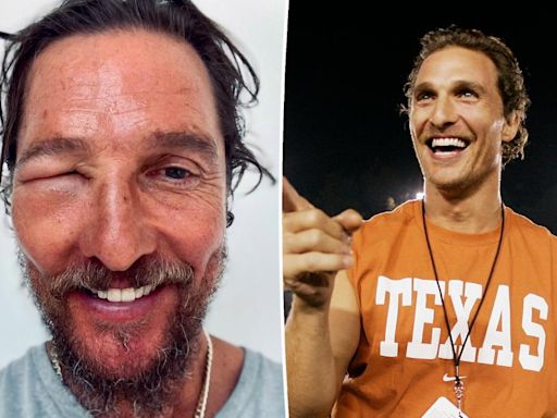 Matthew McConaughey’s eye swells shut after nasty bee sting