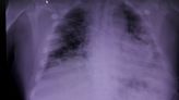 US race-neutral lung assessments to have profound effects, study finds
