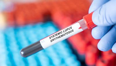Les causes du lupus systémique enfin révélées, une piste de traitement émerge contre cette maladie du système immunitaire