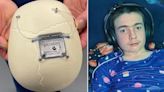 Boy with epilepsy is first in the world fitted with device to control seizures