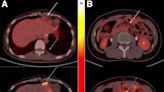 Novel radiotracer rapidly detects gastrointestinal cancer biomarker, identifies patients for targeted therapy