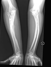 Osteogenesis imperfecta