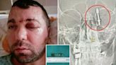 Shock pics show tooth implant screwed into dad’s BRAIN after botched surgery