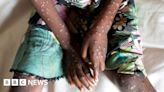 Central African Republic latest to declare mpox outbreak