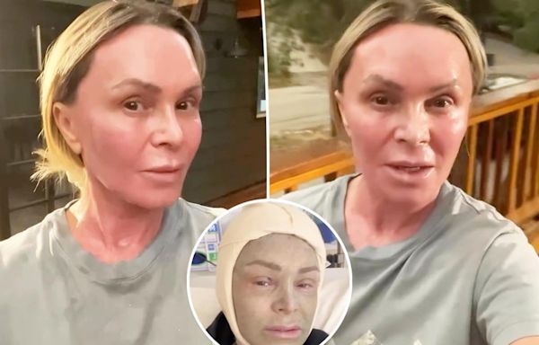 Tamra Judge shares update on ‘sanded and revarnished’ face after plastic surgery: ‘The worst of it is over’