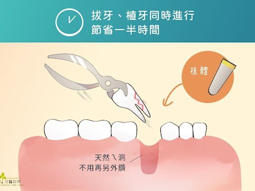 快速植牙不再等待 即拔即植技術大解析