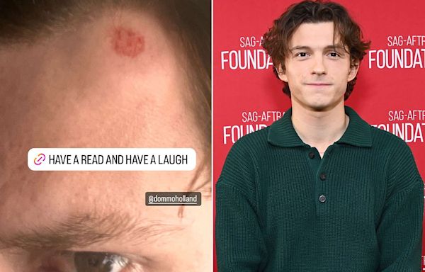 Tom Holland Shares Image of Painful Head Injury from Family Golf Day: ‘You Can Almost See the Dimples’