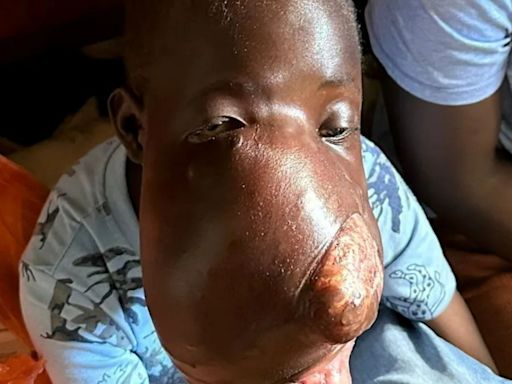 Desperate plea for boy, 9, with tumour so huge it's taking over his face