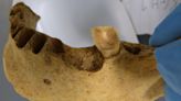 Ancient teeth rarely have a cavity-causing bacteria commonly seen today. A new study reveals why