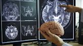 Study identifies brain network linked to stuttering
