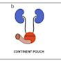 Continent Urinary Diversion