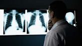 FDA approves new drug for deadly lung cancer
