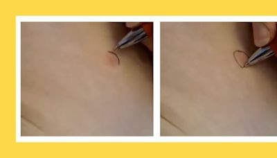 This ‘pen trick’ is a must-know for parents heading into bug bite and rash season