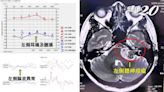 危險耳鳴小心癱瘓、腦出血！這2種耳鳴要警覺 64歲婦人耳鳴背後藏神經瘤