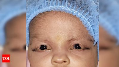 Social media helps 2-month-old with rare syndrome get vision | Kolkata News - Times of India