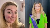 A teen's TikTok account where she showed her acne was taken down because it was deemed 'gruesome content'