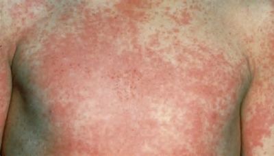 Unusual 'strawberry' symptom of scarlet fever as Victorian disease makes 'notable resurgence'