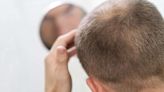 Calvície: como tratar e prevenir a queda de cabelo em homens