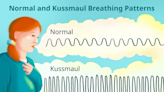 Kussmaul Breathing: Sign of a Medical Emergency