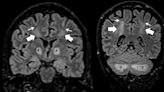Primer caso documentado del impacto cerebral de intoxicación por inhalación de fentanilo
