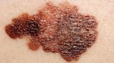 Big dip in melanoma deaths over 10 years reported in NZ