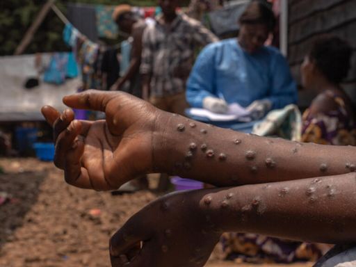 DR Congo receives its first batch of nearly 100,000 doses of mpox vaccine