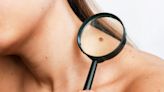 Importance of skin cancer screenings