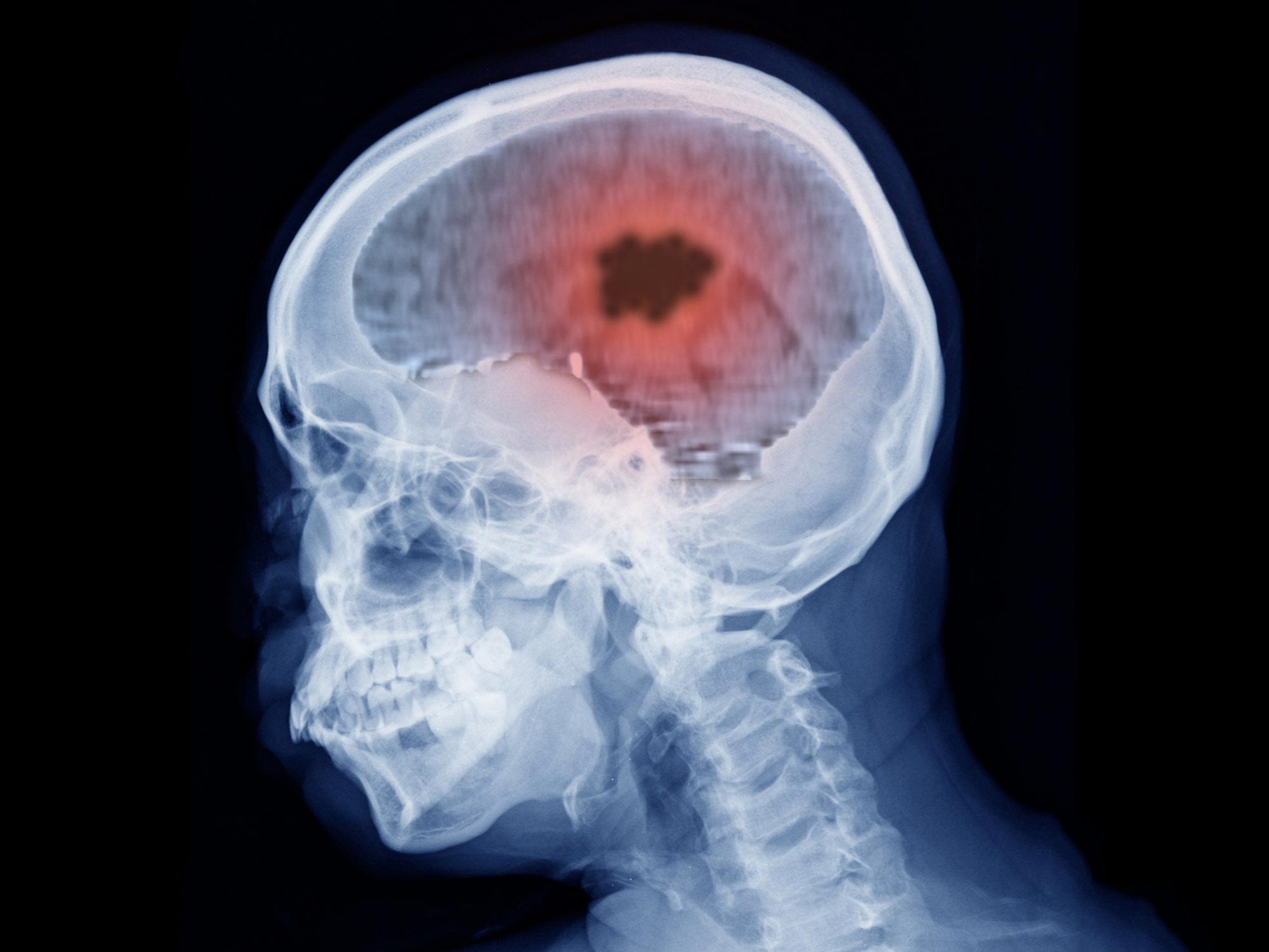New Research Links Popular Hormone Drugs to Brain Tumors
