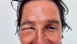 Matthew McConaughey a été défiguré par une piqûre d'abeille