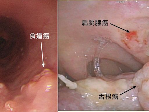 有這些習慣 罹癌風險大十倍