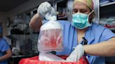 Genetically Modified Pig Kidney Is Transplanted Into Living Patient