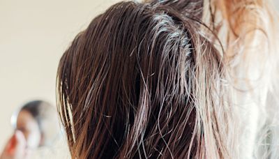 Doctors Share 3 Essential Treatments To Prevent And Treat Hair Loss At The Crown