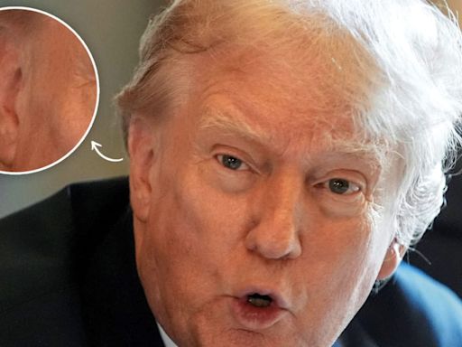 Donald Trump Seen in Public Without Ear Bandage