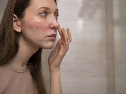 Cuidá tu piel: las 6 cosas que tenés que evitar si sufrís rosácea