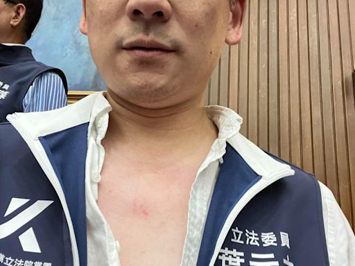 葉元之爆遭攻擊！「傷勢照曝光」怒吼有夠扯：民進黨暴力黨