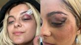 Bebe Rexha reveals black eye after being struck by cellphone during concert