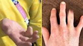 Australian Olympian amputated his broken finger to compete at Paris 2024 Games