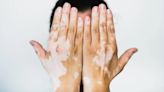 Día Mundial del Vitiligo: a quiénes afecta y cuáles son sus síntomas