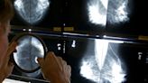 Mammograms should start at 40 to address rising breast cancer rates at younger ages, panel says