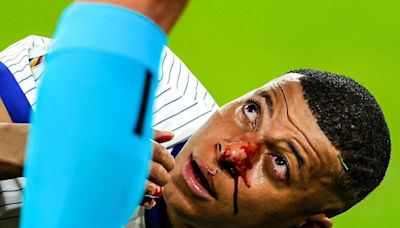 'Any Ideas for Masks': Kylian Mbappe Shares First Reaction After Suffering Broken Nose In France's Euro 2024 Opener - News18