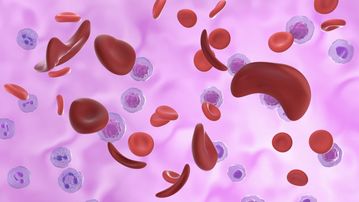 What is sickle cell anaemia?
