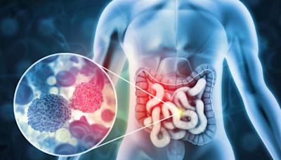 Bloody Stool: Is It A Sign of Colon Cancer? Know Other Symptoms