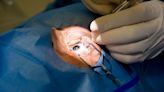 Cyclosporine Drops Ease Discomfort After Cataract Surgery