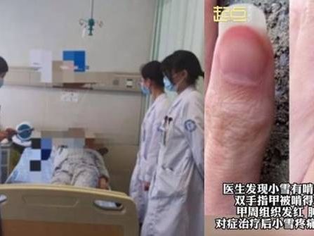 浙江14歲女常咬手引關節炎敗血症！醫警告：長期嚴重危害健康