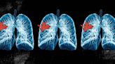 How diagnosing and treating asthma, COPD early can significantly improve quality of life
