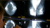 San Diego advocates criticize new breast cancer screening guidelines