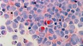 New research identifies promising drug combination for multiple myeloma treatment