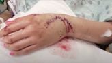 Teen Punches Shark In Face to Survive Texas Gulf Attack