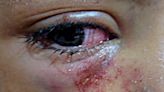 Niño de 8 años pierde ojo derecho por pedrada que recibió en recreo